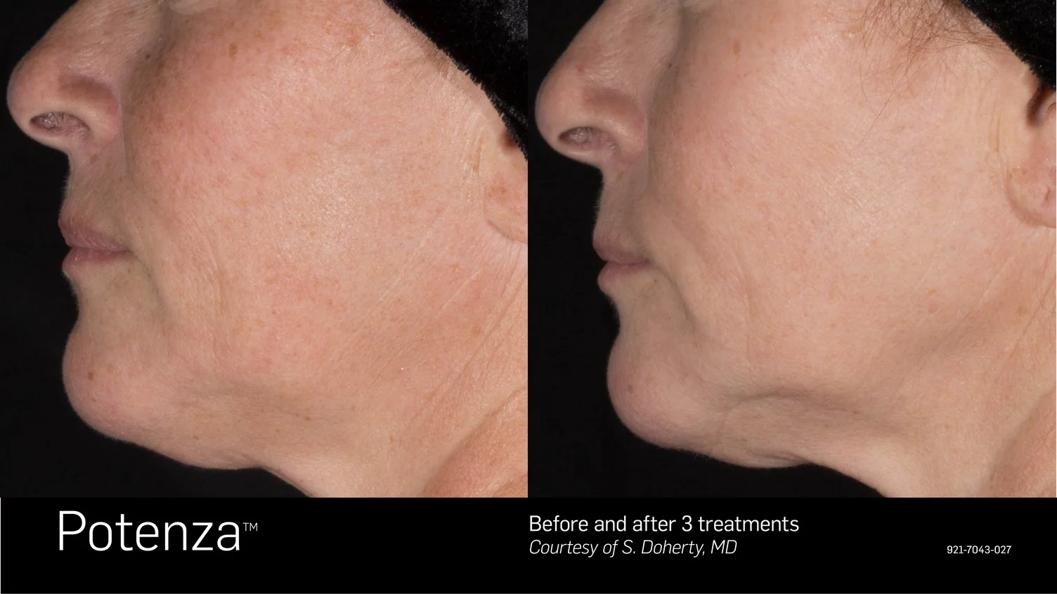 Micro needling before and after Richmond Hill ON
