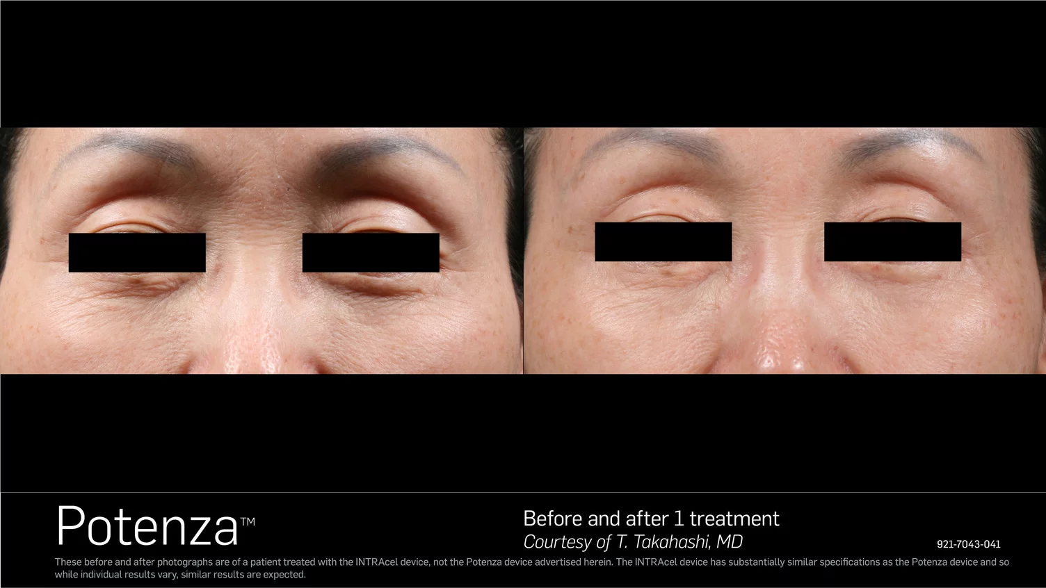 Potenza Microneedle RF Before and After Toronto