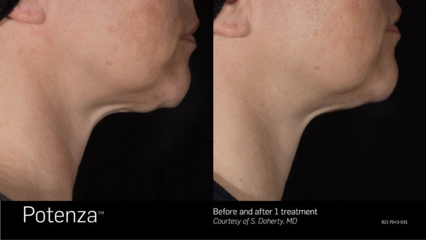 Potenza RF Micro Needling Before and After