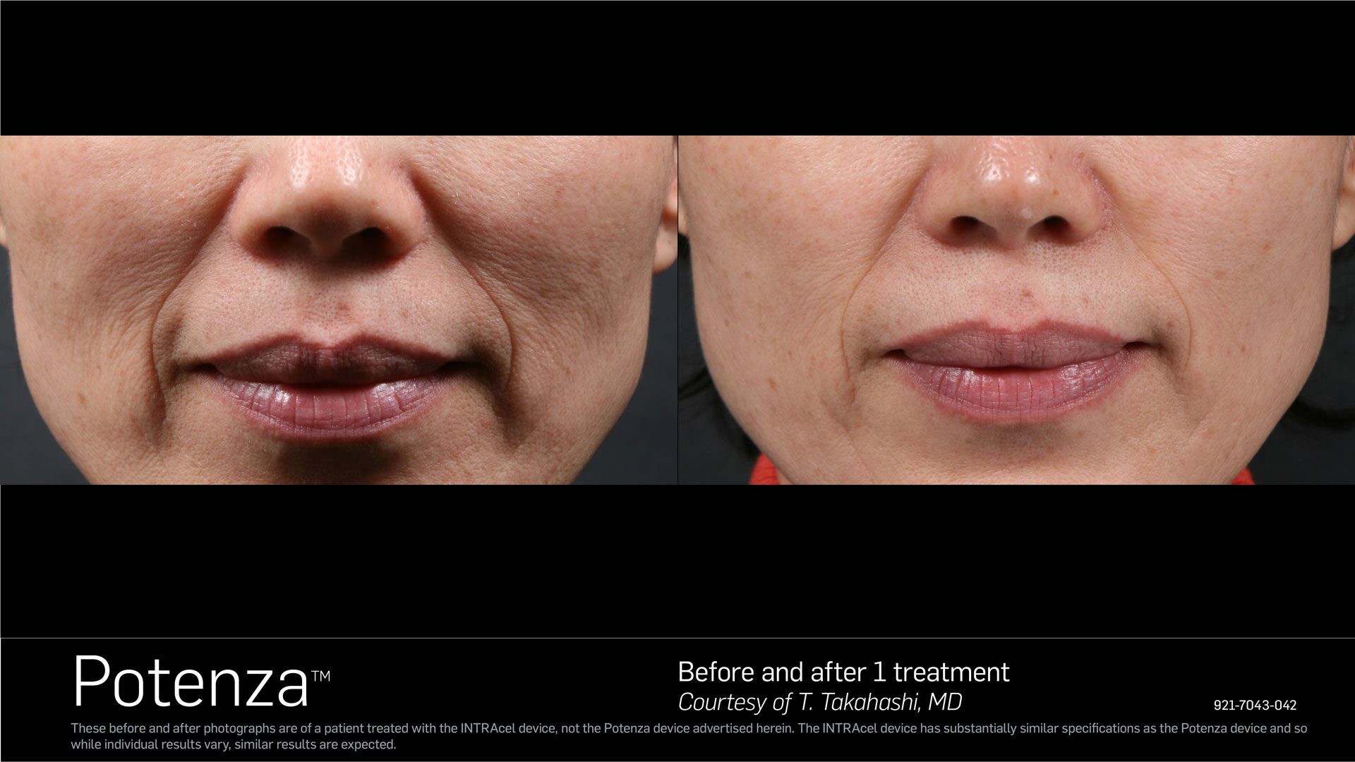 Potenza RF Microneedling Before and After Toronto