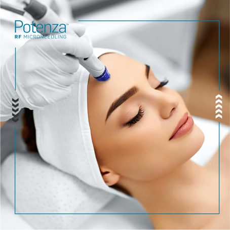POTENZA RF MICRONEEDLING:  BEST NON-SURGICAL SKIN TIGHTENING TREATMENT?