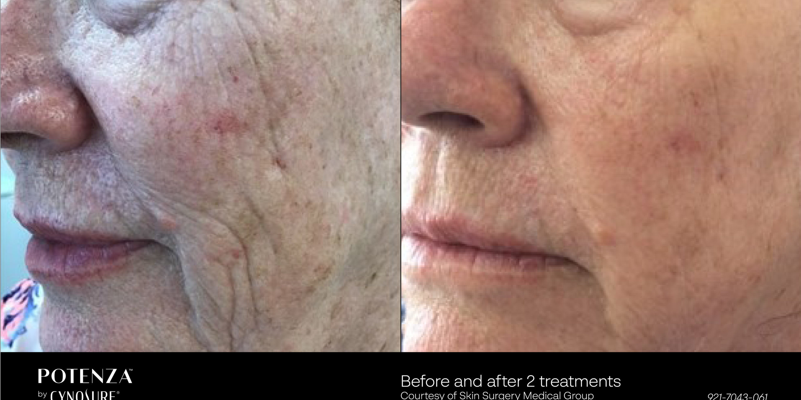 micro needling before and after Ontario