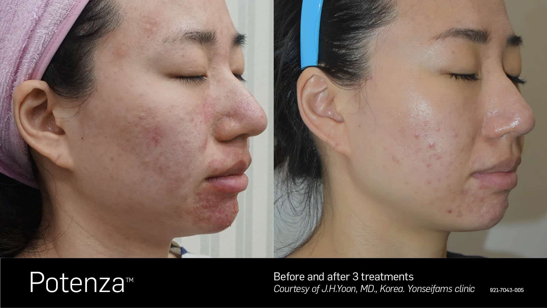 rf microneedling before and after acne Toronto