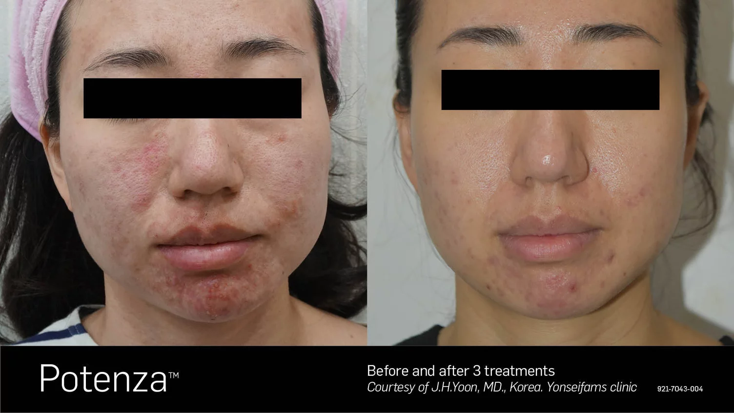 rf microneedling before and after acne scars